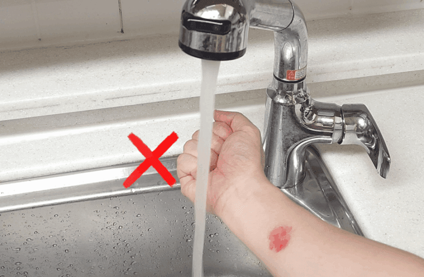 화상 입었을때 절대 '이것' 하지마세요! 그동안의 화상 대처법은 모두 틀린 꿀팁이었습니다. 6