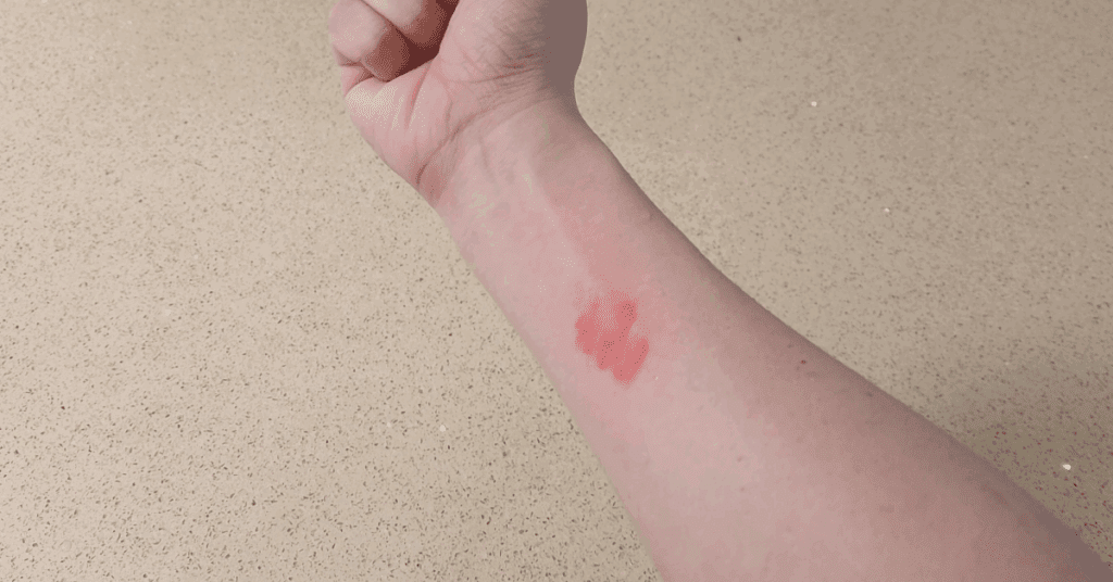 요리나 일상 중 생길 수 있는 화상, 잘못된 대처는 흉터를 남깁니다. 올바른 화상 대처법과 뜨거운 물 화상 응급처치 방법을 단계별로 알려드립니다. 